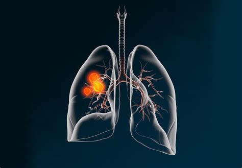 akciğer kanseri lenf bezlerine sıçraması